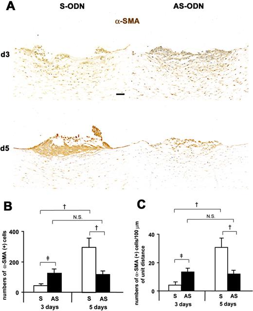 Cx43 AS-ODN treatment inhibits EMT and formation of retrocorneal fibrous membrane in the rat cornea after scrape injury. (A) Immunohistochemistry for α-SMA in cross sections on days 3 and 5 after injury revealed that on day 3, the wound was closed in the AS-ODN-treated cornea but remained open in the S-ODN-treated one. On day 5, the wounds were completely closed in both corneas. No increases in the number of α-SMA-positive myofibroblasts between days 3 and 5 were found in the AS-ODN-treated cornea, whereas the number of myofibroblasts in the S-ODN-treated cornea was markedly increased during the same period. Scale bar, 100 μm. (B, C) Morphometry for α-SMA-positive myofibroblasts. The data are expressed as the number of α-SMA-positive myofibroblasts per retrocorneal lesion (B) and the number of α-SMA-positive myofibroblasts per 100 μm of the linear horizontal distance across the retrocorneal lesion occupied by multilayered α-SMA-positive myofibroblasts (C). On day 5 after injury, the number of myofibroblasts in Cx43 AS-ODN-treated corneas was less than half that in S-ODN-treated corneas. Although more α-SMA-positive myofibroblasts were found in Cx43 AS-ODN-treated corneas than in the S-ODN-treated corneas on day 3 after injury, the number of myofibroblasts in Cx43 AS-ODN-treated corneas on day 3 was still less than half that in the S-ODN-treated corneas on day 5, and no increases in their number were observed from days 3 to 5. Mean ± SD; n = 5. †P < 0.01; ‡P < 0.05 (Scheffé’s test).