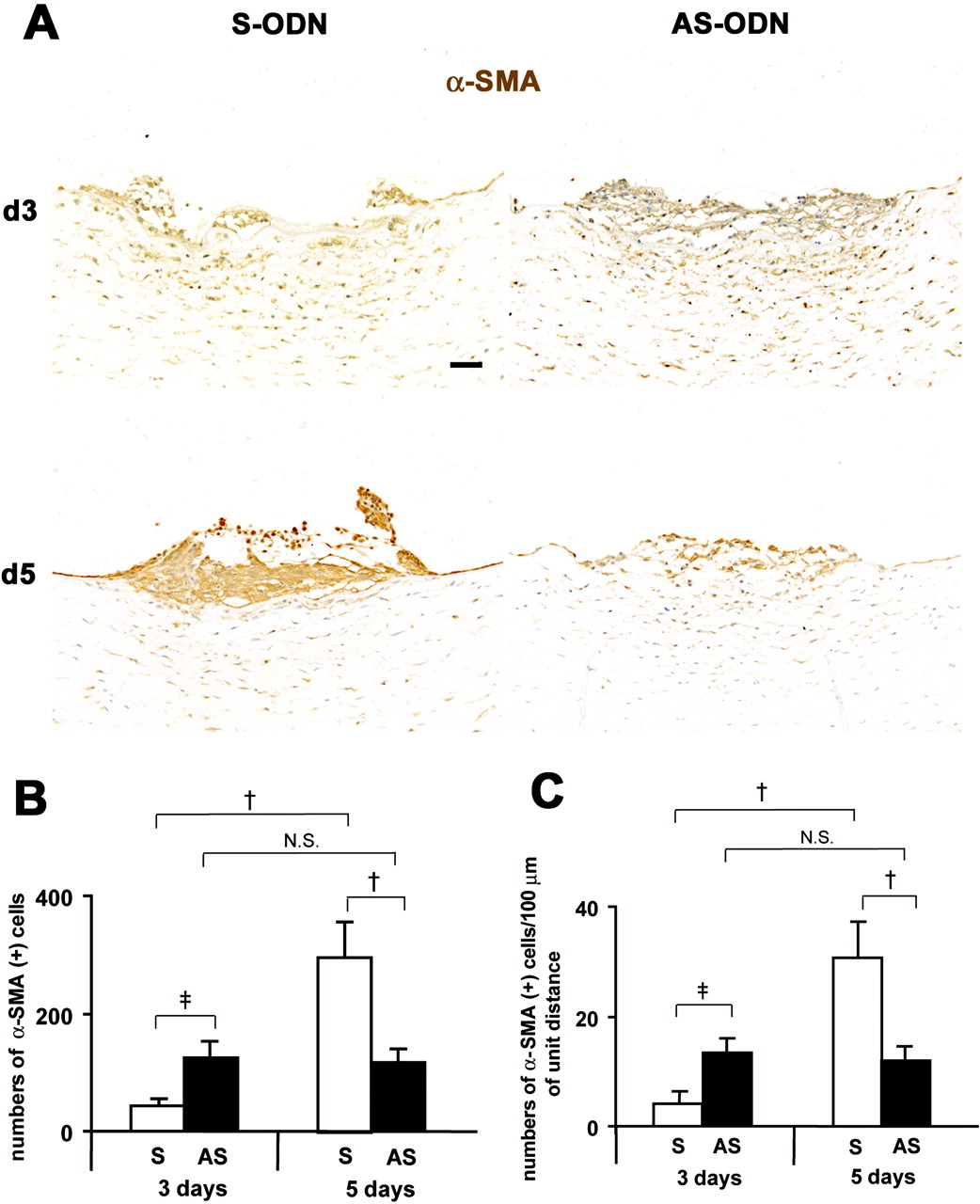 Cx43 AS-ODN treatment inhibits EMT and formation of retrocorneal fibrous membrane in the rat cornea after scrape injury. (A) Immunohistochemistry for α-SMA in cross sections on days 3 and 5 after injury revealed that on day 3, the wound was closed in the AS-ODN-treated cornea but remained open in the S-ODN-treated one. On day 5, the wounds were completely closed in both corneas. No increases in the number of α-SMA-positive myofibroblasts between days 3 and 5 were found in the AS-ODN-treated cornea, whereas the number of myofibroblasts in the S-ODN-treated cornea was markedly increased during the same period. Scale bar, 100 μm. (B, C) Morphometry for α-SMA-positive myofibroblasts. The data are expressed as the number of α-SMA-positive myofibroblasts per retrocorneal lesion (B) and the number of α-SMA-positive myofibroblasts per 100 μm of the linear horizontal distance across the retrocorneal lesion occupied by multilayered α-SMA-positive myofibroblasts (C). On day 5 after injury, the number of myofibroblasts in Cx43 AS-ODN-treated corneas was less than half that in S-ODN-treated corneas. Although more α-SMA-positive myofibroblasts were found in Cx43 AS-ODN-treated corneas than in the S-ODN-treated corneas on day 3 after injury, the number of myofibroblasts in Cx43 AS-ODN-treated corneas on day 3 was still less than half that in the S-ODN-treated corneas on day 5, and no increases in their number were observed from days 3 to 5. Mean ± SD; n = 5. †P < 0.01; ‡P < 0.05 (Scheffé’s test).