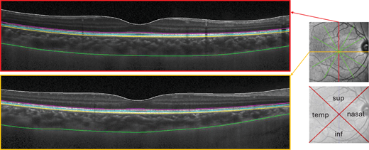 OCT segmentation. The star scan was acquired using OCT and the anterior (yellow line) and posterior (green) choroidal boundaries were detected using semiautomated routines. Subfoveal choroidal thickness and choroidal area were calculated from the boundaries in each of the six scans. Regional area was calculated using the appropriate part of each B-scan in each of the regions shown.