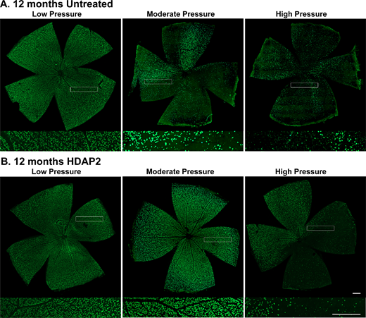 Retinal wholemounts from 12-month-old animals. RBPMS-stained wholemounts to show distribution of RGCs in untreated and HDAP2-treated eyes; higher magnification insets show representative labeling. Pressure groups: low = cIOP < 40 mm Hg, moderate = cIOP 40 to 80 mm Hg, and high = cIOP > 80 mm Hg). (A) Untreated retinas exhibited prominent RGC loss at moderate (cIOP = 75 mm Hg) and high pressures (cIOP = 85 mm Hg). (B) Retinas from 12-month-old HDAP2-treated eyes maintained higher RGC densities compared with untreated eyes at similar pressures (moderate cIOP = 52 mm Hg and high cIOP = 103 mm Hg). Scale bars = 500 µm.